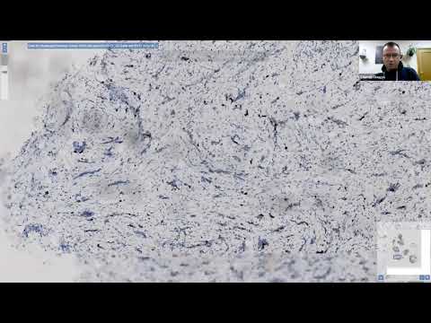 Видео: Высокодифференцированные нейроэндокринные опухоли желудка