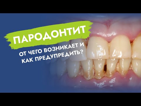 Видео: Пародонтит. От чего возникает и как предупредить?