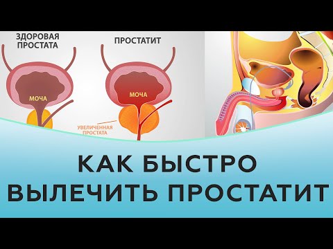 Видео: Простатит. Как быстро вылечить воспаление простаты.