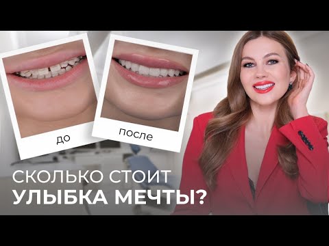 Видео: ШОК! ИЗМЕНИЛАСЬ ЗА ГОД |  БРЕКЕТЫ, ВИНИРЫ