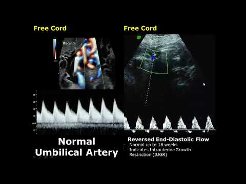 Видео: Допплерография пупочной артерии: нормальные и патологические изображения | Спектральная допплерог...