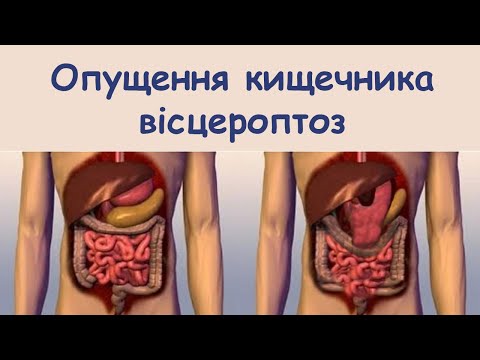 Видео: Опущення кишечника причини, симптоми, діагностика, дієта, лікування. Лічниця сестер Похмурських.