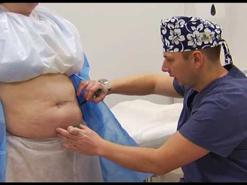 Видео: Абдоминопластика