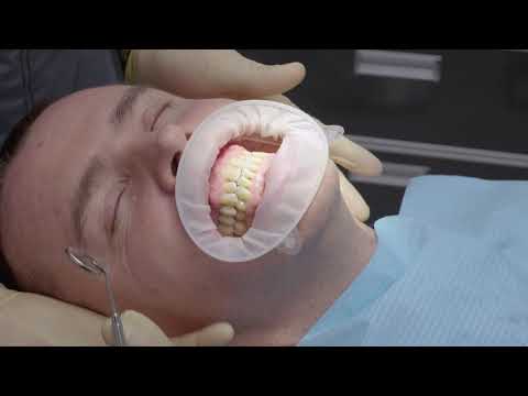 Видео: Как устанавливают коронки на импланты