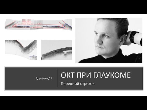 Видео: ОКТ при глаукоме  Передний отрезок 5/7