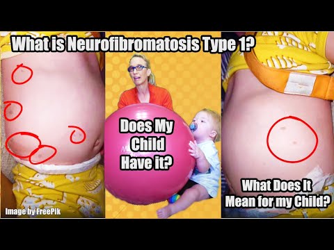 Видео: Что такое нейрофиброматоз 1 типа? Есть ли это у моего ребенка? и что это значит для моего ребенка?