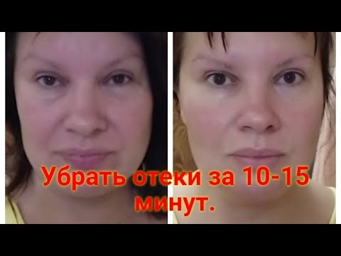 Видео: Как убрать отеки на лице и глазах за 10-15 минут?