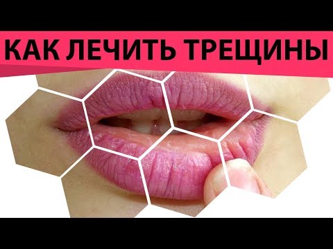 Видео: Трещины на губах. Почему губы трескаются и как лечить. Как мед лечит трещины на губах!