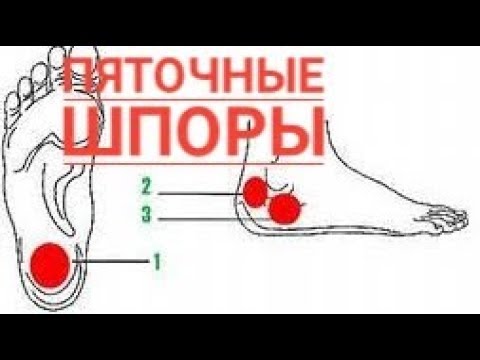 Видео: БОЛЬНО НАСТУПАТЬ НА ПЯТКУ? Самые эффективные упражнения от против «гвоздя в пятке»