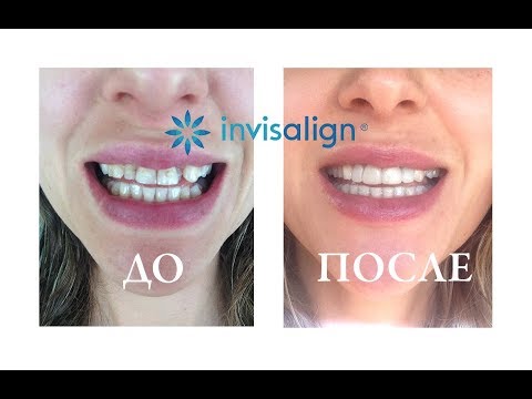 Видео: ДО и ПОСЛЕ элайнеры (капы) Инвизилайн (Invisalign) | Результат и отзыв