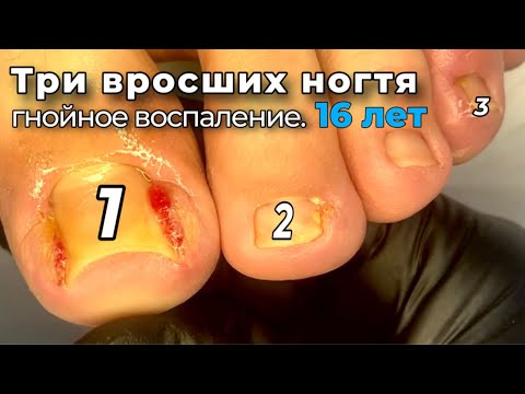 Видео: Грануляция, куски «дикого мяса», врастание с двух сторон. Три вросших ногтя на стопе