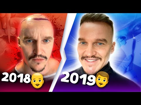 Видео: 1 год после трансплантации волос.