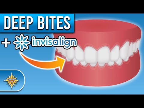 Видео: Может ли Invisalign исправить глубокий прикус?