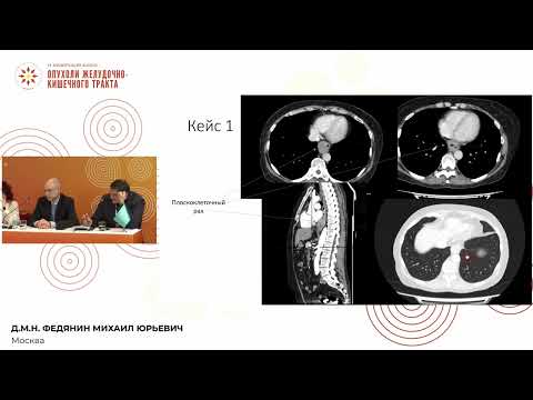 Видео: Опухоли желудочно-кишечного тракта. Разбор сложных случаев: молодые онкологи vs. эксперты