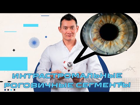 Видео: Интрастромальные роговичные сегменты или кольца (ИРС) - Спасение от кератоконуса?