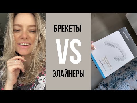 Видео: МОЯ ИСТОРИЯ НОШЕНИЯ БЕРЕКЕТОВ И ЭЛАЙНЕРОВ|стоимость|больно или нет|что лучше