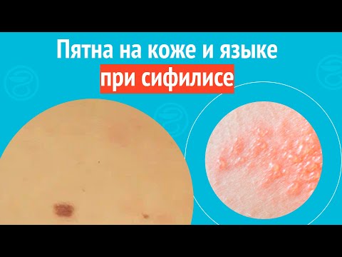 Видео: ☹️ Пятна на коже и языке при сифилисе. Клинический случай №1587