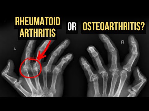 Видео: Ревматоидный артрит против остеоартрита — объяснение