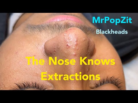Видео: Удаление угрей в носу. Чёрные точки, белые угри, милиумы. Кератиновые пробки удаляются путём глуб...