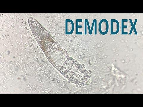 Видео: Клещ Demodex. Современные методы лечения.