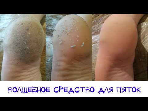 Видео: Волшебное средство для пяток. Моментальный эффект!