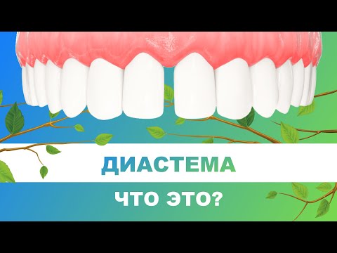 Видео: 👄 Диастема - что это такое. Нужно ли лечить диастему?