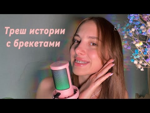 Видео: АСМР| болталка о брекетах🫣 ASMR| about braces