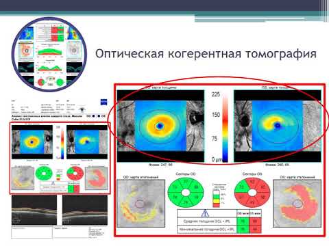 Видео: ОКТ в диагностике глаукомы