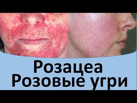 Видео: Розацеа. Розовые угри.