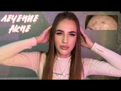 Видео: Как я избавилась от акне за месяц? Лечение. Моя история.