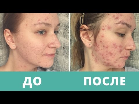 Видео: Дневник АКНЕкутана 11. СТРАШИЛКИ ПЕРВОГО МЕСЯЦА