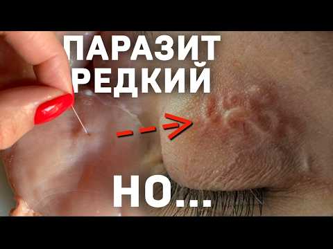 Видео: Паразиты: как не получить и правильно вылечиться