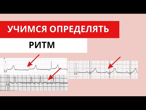 Видео: Учимся определять ритм. Пошаговая инструкция и ЭКГ примеры. Анализ ЭКГ.