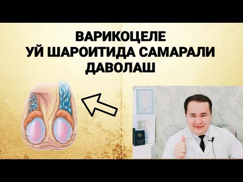 Видео: Варикоцеле уй шароитида даволаш / Varikoseli davosi