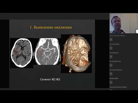 Видео: КТ острых ишемических инфарктов