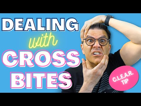 Видео: Как бороться с перекрестным прикусом при лечении с помощью прозрачных элайнеров