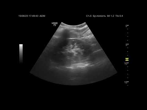Видео: Ультразвуковая диагностика (УЗИ). Доктор Иогансен. Видеопримеры. Выпуск 30. Методика УЗИ почек.