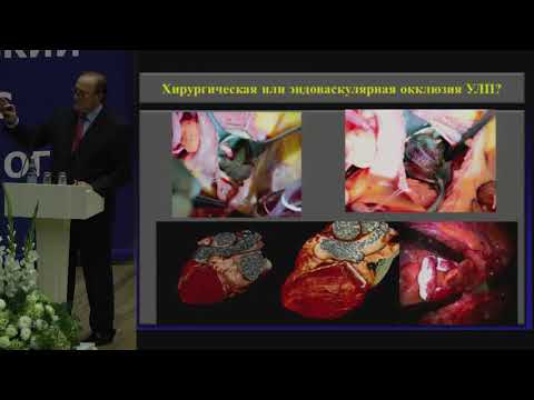 Видео: Ревишвили А.Ш. Фибрилляция предсердий: новые представления о механизмах и методах лечения | Аритмия
