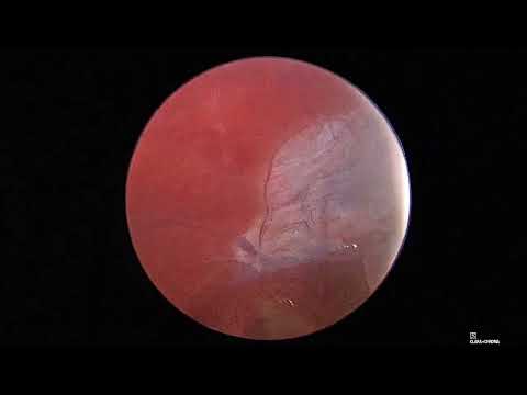 Видео: с медвежонок, холецистэктомия