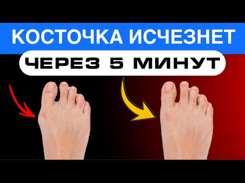 Видео: КОСТОЧКА на большом пальце ноги исчезнет НАВСЕГДА. Нужно расслабить эти мышцы 