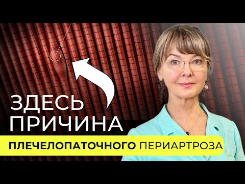 Видео: Когда болит плечо: подробный ответ на вопрос о плечелопаточном периартрозе