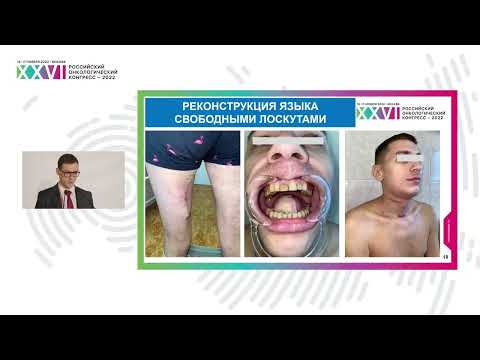 Видео: Хирургический этап с реконструктивным компонентом в лечении больных раком полости рта