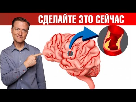 Видео: Профилактика инсульта и микроинсульта. Защитите себя ✅