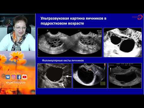 Видео: Экспертология | Функциональные кисты яичников Пустотина О.А.