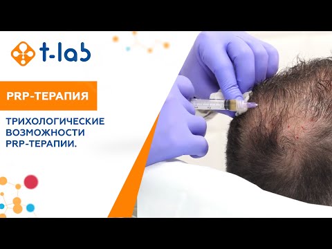 Видео: Трихологические возможности PRP-терапии.