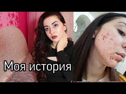 Видео: КАК Я ВЫЛЕЧИЛА ПРЫЩИ ЗА 3 ДНЯ В ДОМАШНИХ УСЛОВИЯХ Ayka Emilly