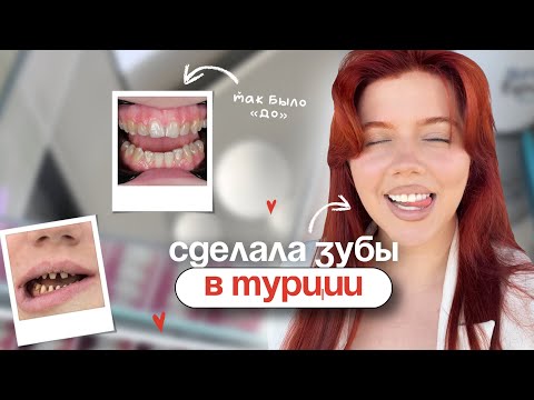 Видео: СДЕЛАЛА ЗУБЫ В ТУРЦИИ | сточили и поставили новые?😳