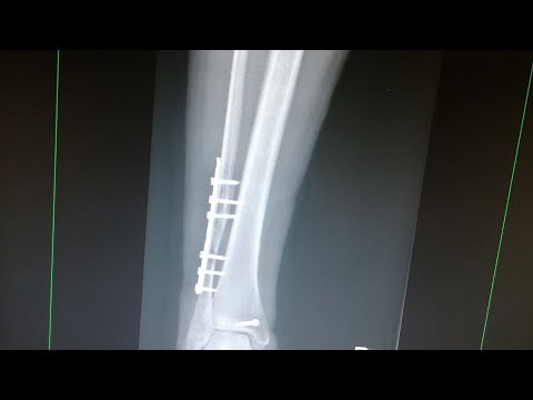 Видео: Как я сломала ногу😒Полный рассказ с фото. Остиосинтез малоберцовой кости. полный диагноз в описании🤕
