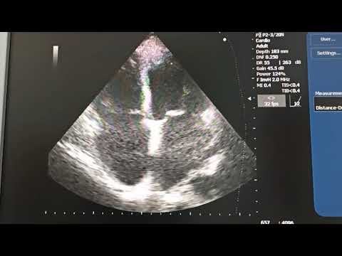 Видео: Оценка легочной артерии правого желудочка и предсердий у пациента с фибрилляцией предсердий