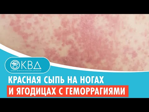 Видео: 🦵🦵 Красная сыпь на ногах и ягодицах с геморрагиями. Клинический случай №611